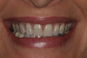 Smile design case 3 before photo
