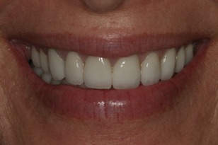 Smile design case 3 after photo
