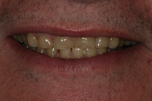 Smile design case 4 before photo