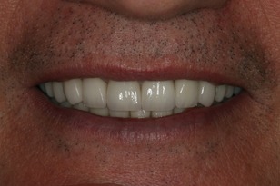 Smile design case 4 after photo