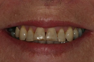 Smile design case 5 before photo