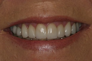 Smile design case 5 after photo