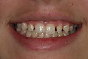 Smile design case 6 before photo
