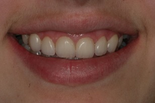 Smile design case 6 after photo