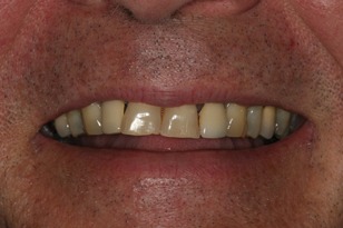 Smile design case 7 before photo