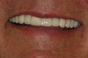 Smile design case 7 after photo