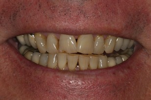 Smile design case 9 before photo