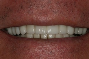 Smile design case 9 after photo