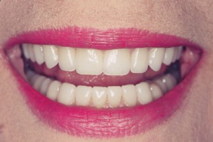 Smile design case 10 after photo