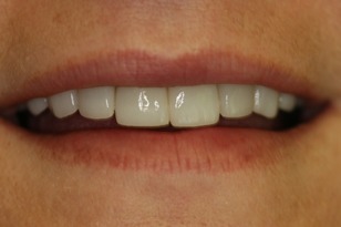 Smile design case 11 before photo