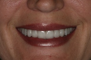 Smile design case 11 after photo