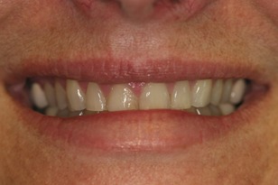 Smile design case 12 before photo