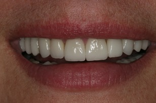 Smile design case 12 after photo
