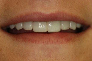 Smile design case 1 before photo