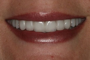 Smile design case 1 after photo